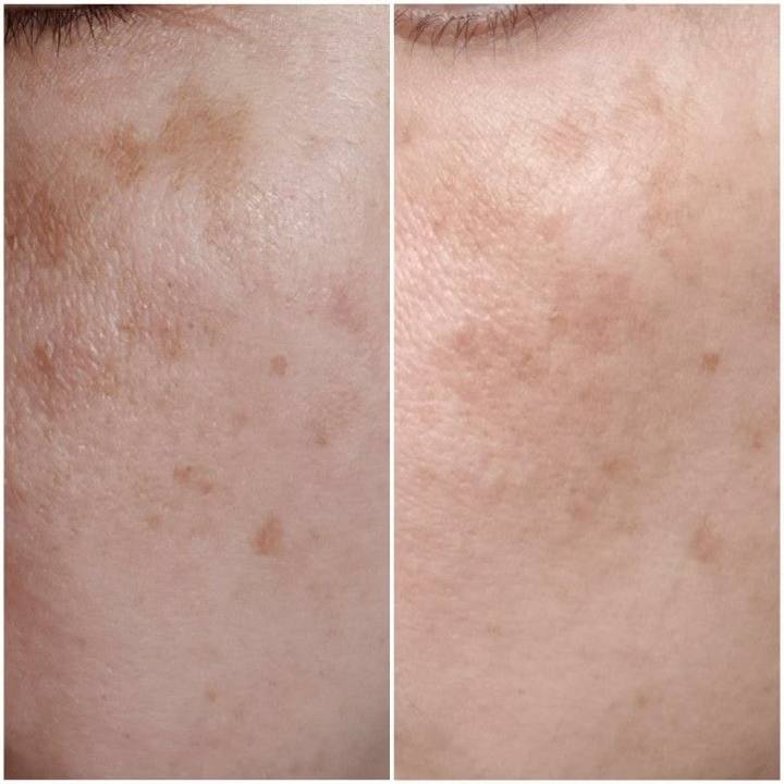 Foto before after flek hitam pengguna Ukhtiy — kulit lebih cerah dan merata setelah 3 minggu pemakaian